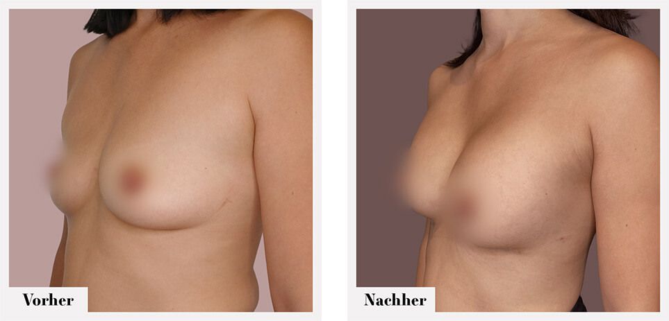 breast augmentation zug Dr. Kelly